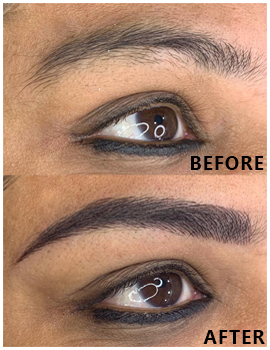 Eyes Before After
