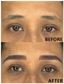 Eyes Before After