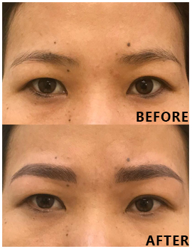 Eyes Before After