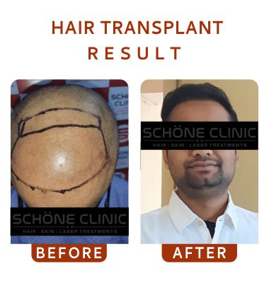 Hair Transplant Result