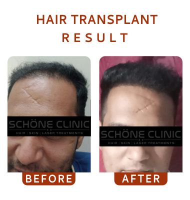 Hair Transplant Result