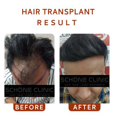 Hair Transplant Result