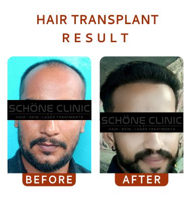 Hair Transplant Result