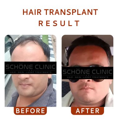Hair Transplant Result