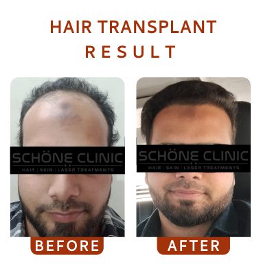 Hair Transplant Result