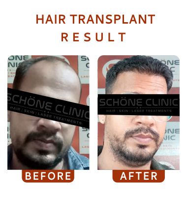 Hair Transplant Result