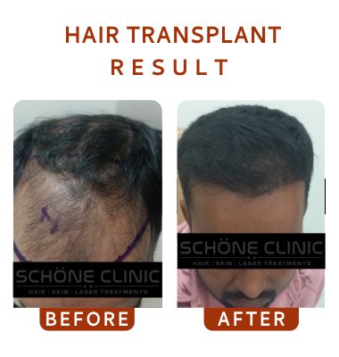 Hair Transplant Result