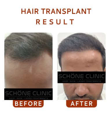Hair Transplant Result
