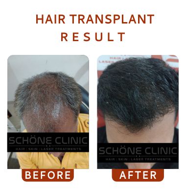 Hair Transplant Result