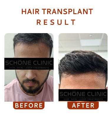 Hair Transplant Result