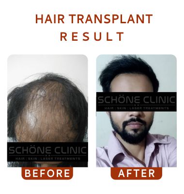Hair Transplant Result